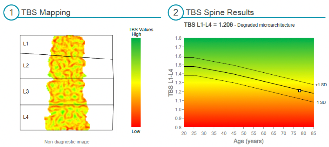 IDXA Bone Density mapping